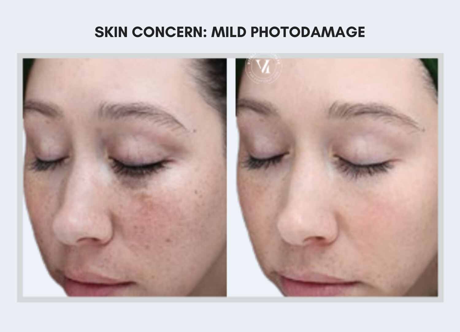 VI PEEL before and after VI PEEL before and after